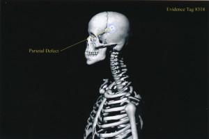 Exhibit-396-Graphic-Skeleton-Parietal-Defect-1024x684