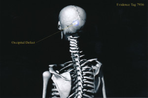 Exhibit-399-Graphic-Skeleton-Occipital-Defect-1024x683