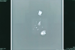 Exhibit-431-Xray-Bone-Fragments-1024x681