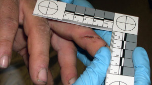 exhibit-193-injury-to-Avery-finger
