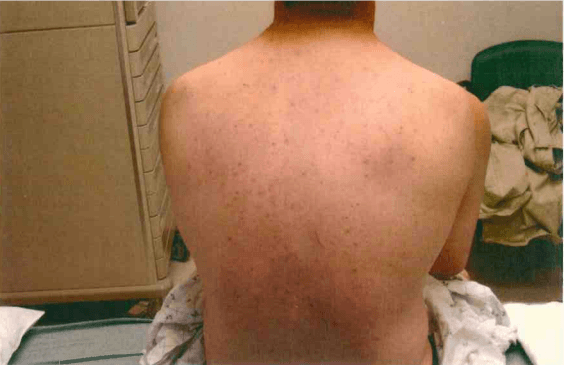Scratches on Bobby Dassey's Back
